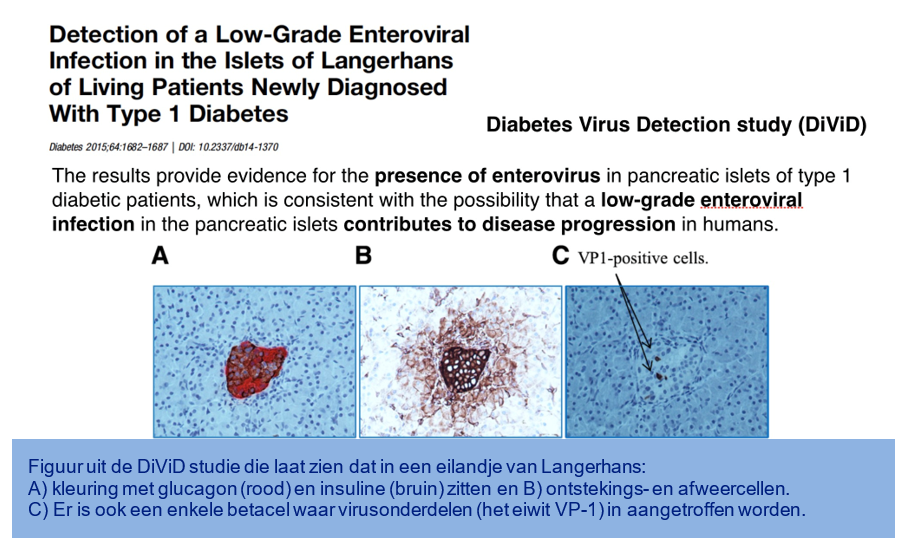 Presence of enterovirus in pancreatic islets type 1 diabetes